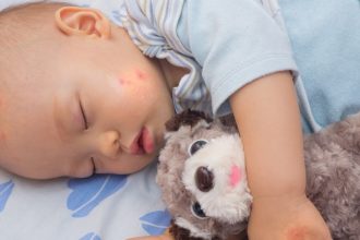 How to Treat and Prevent Mosquito Bites on Babies